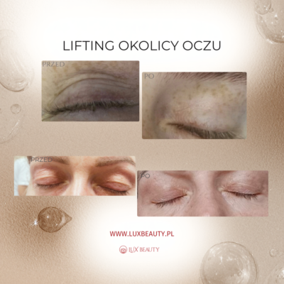 blefaroplastyka powiek