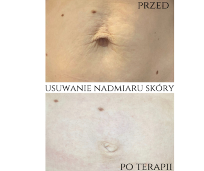 usuwanie nadmiaru skóry