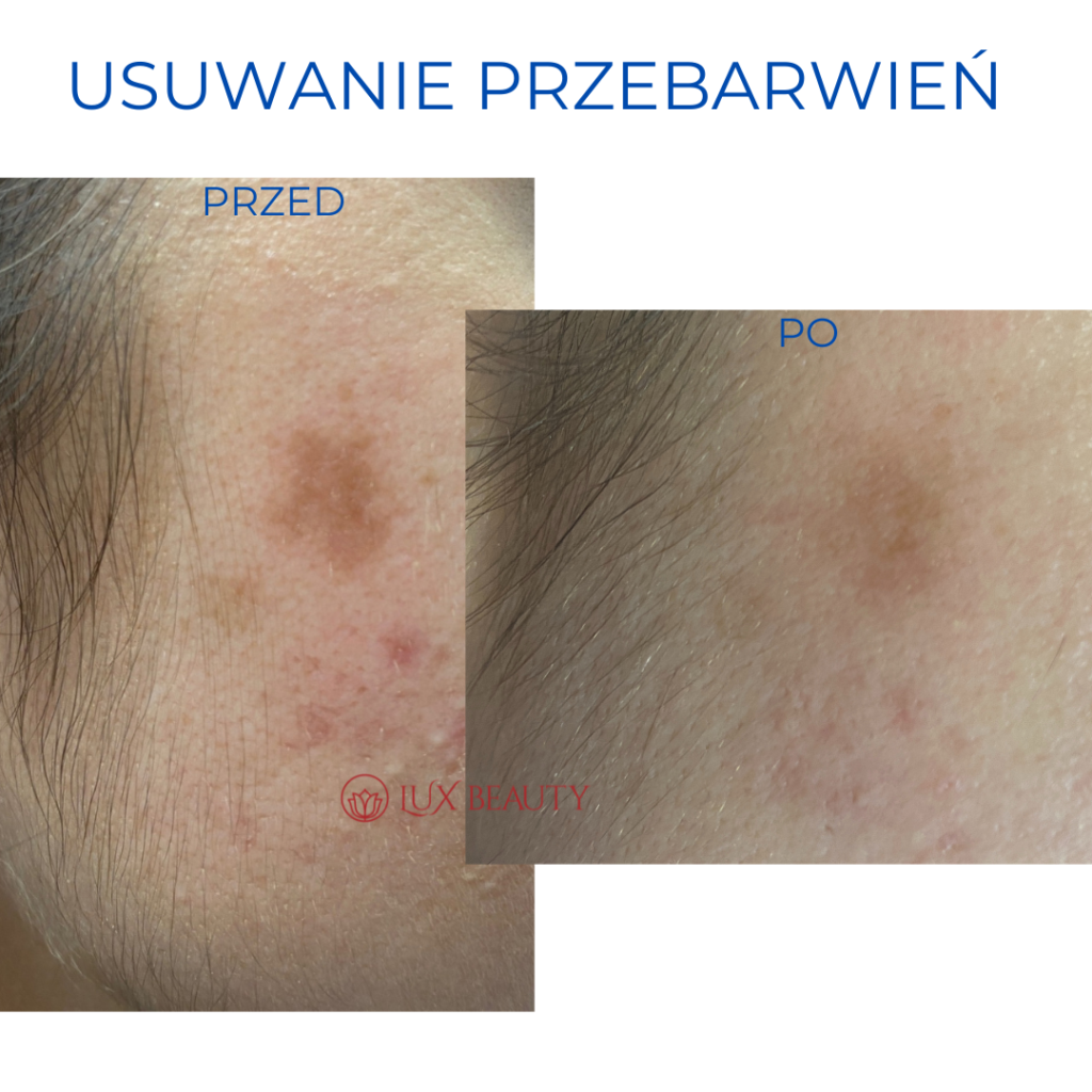 zabieg na przebarwienia