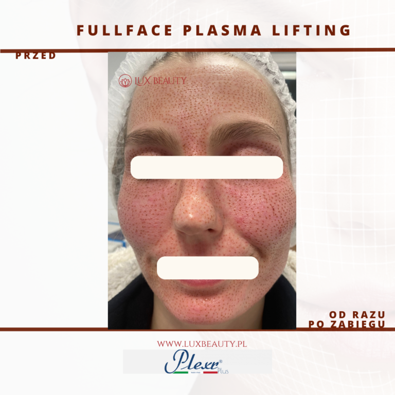 fullface lifting plazma, plazma plexr plus, lifting twarz